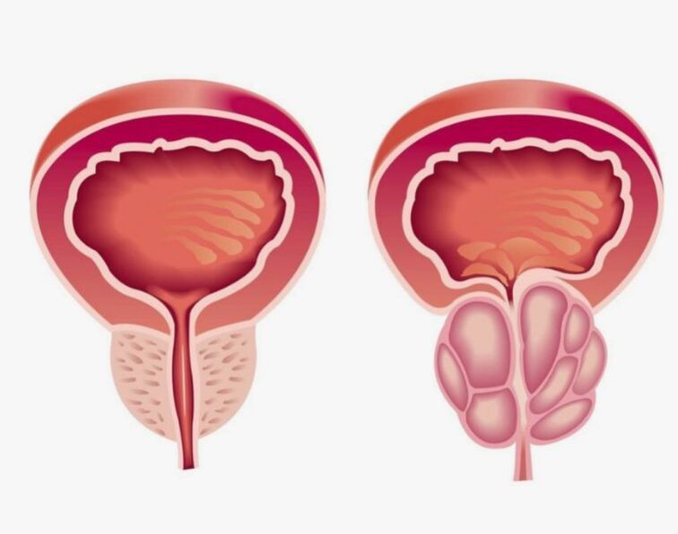 zdrava i bolesna prostata